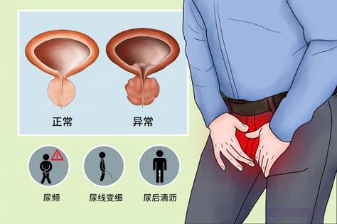 男性前列腺肥大怎么办？