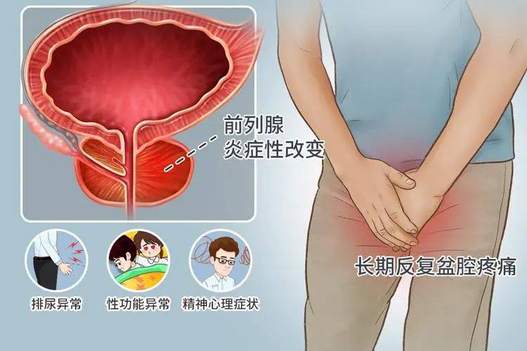 湿热下注引发前列腺炎？