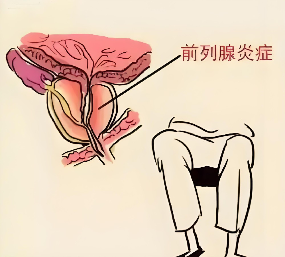 慢性前列腺炎