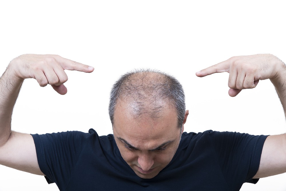 男性脱发