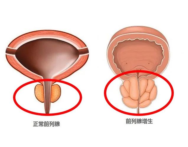 前列腺增生