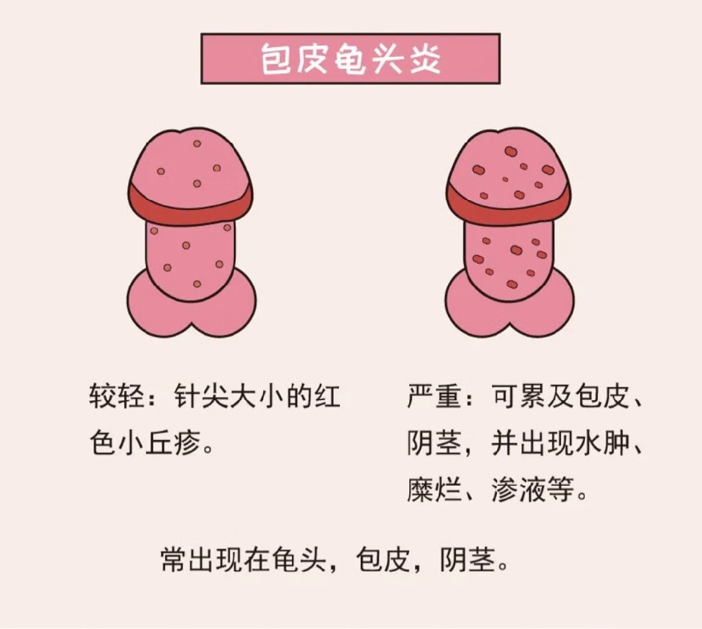 包皮龟头炎