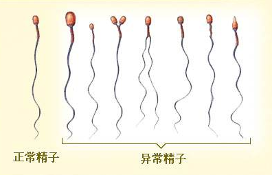 精液异常