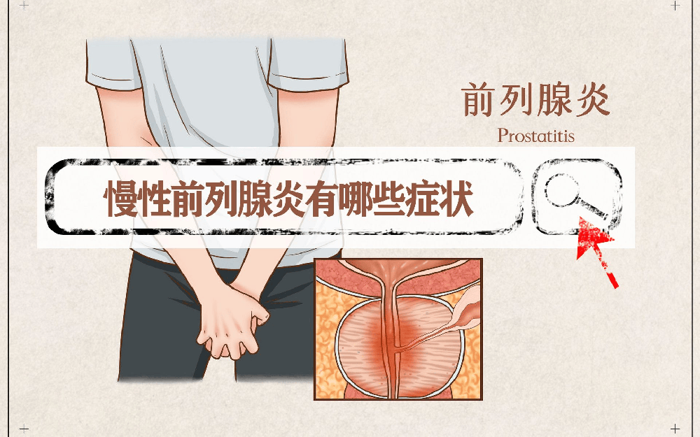 慢性前列腺炎