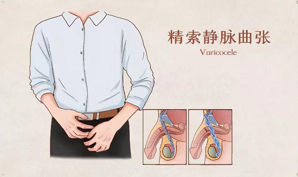 精索静脉曲张