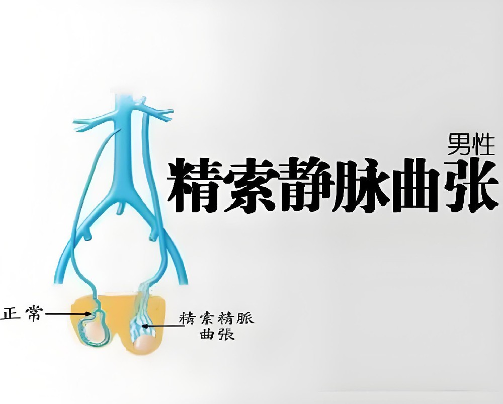 男性精索静脉曲张