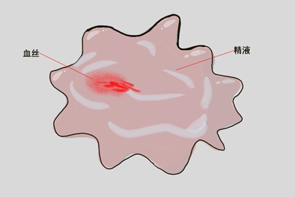 男性血精