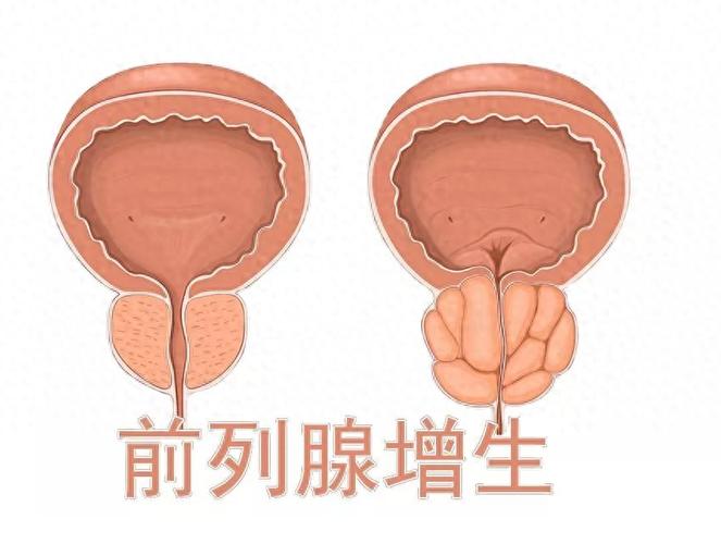 男性前列腺增生