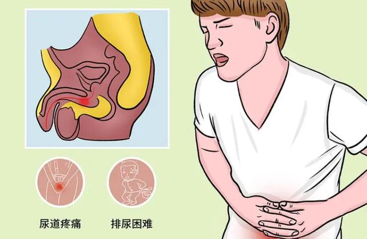 会阴部刺痛、排尿涩滞