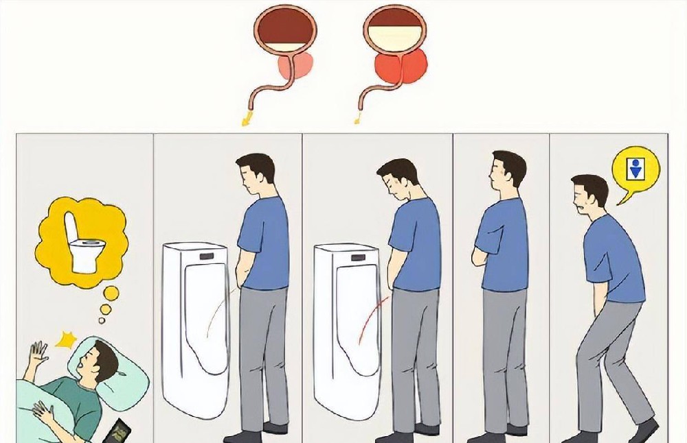 尿线变细、尿不尽