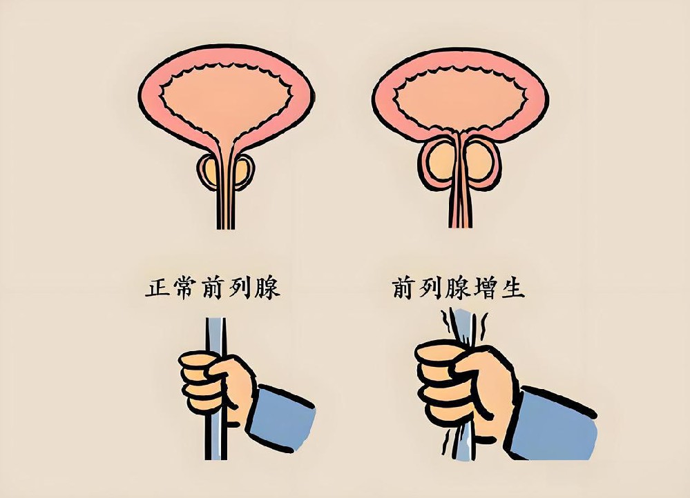 前列腺增生和前列腺炎区别
