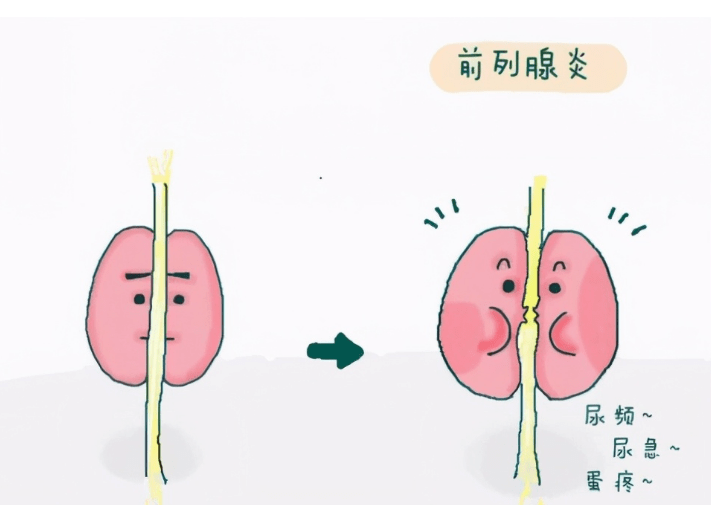 年轻男性前列腺炎会影响生育吗?