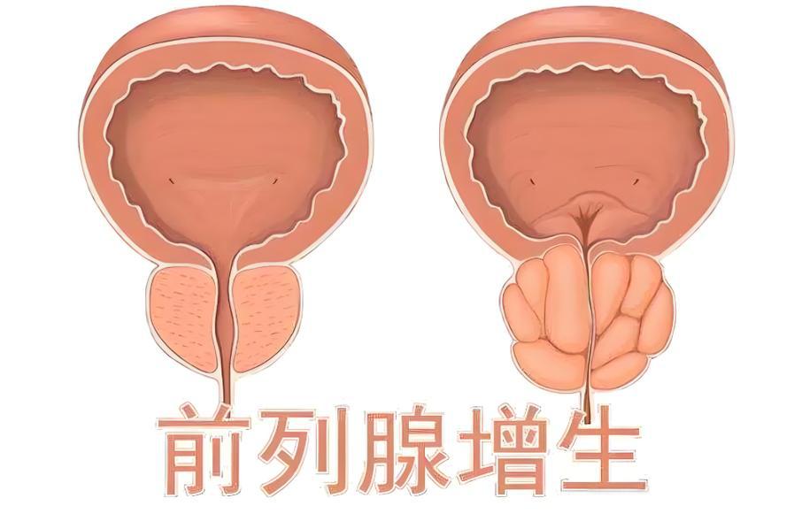 前列腺增生患者能憋尿锻炼吗？