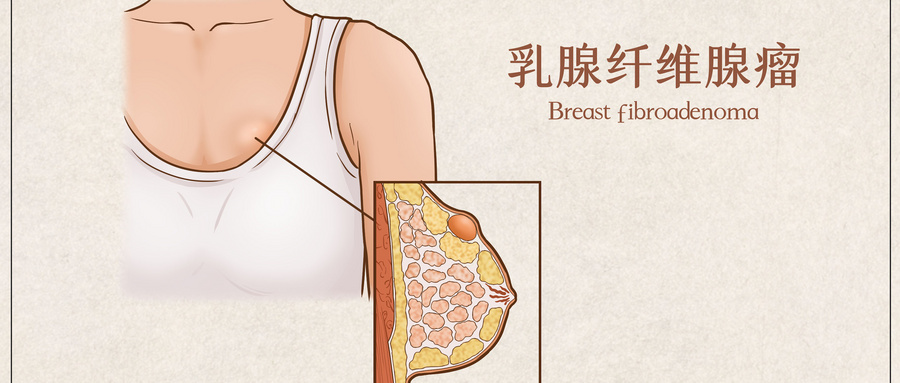 摄图网_401789492_wx_乳腺纤维腺瘤医疗插画示意图(企业商用).jpg